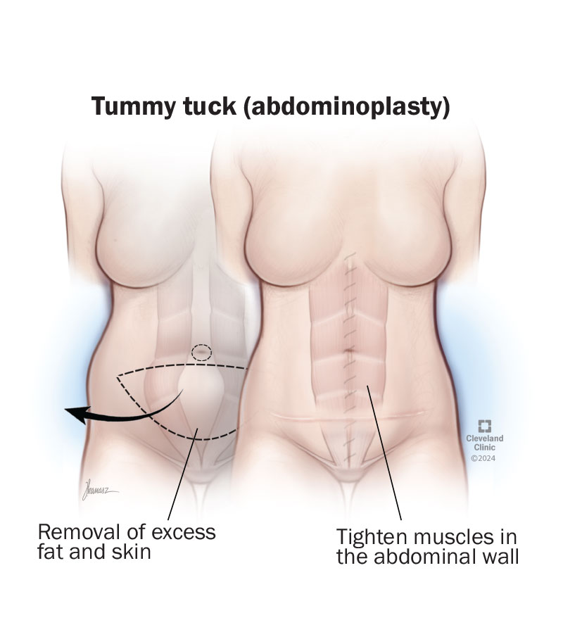 Best Tummy Tuck In Austin